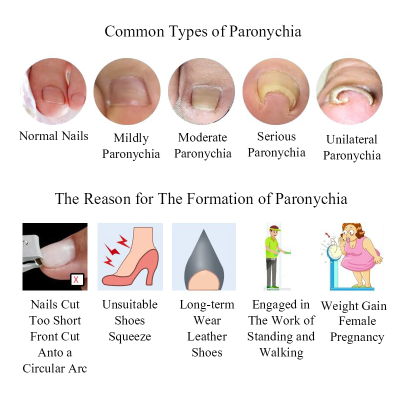 Ingrown-Toenail-Straightening-Clip-Curved-BS-Brace-Toenails-Thick-Paronychia-Correction-Tool-1154773